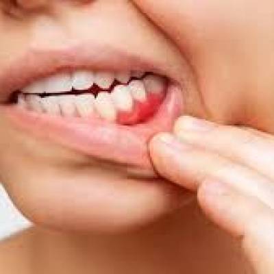 Câncer de boca está entre os mais incidentes no Brasil - Notícias - Mato Grosso digital